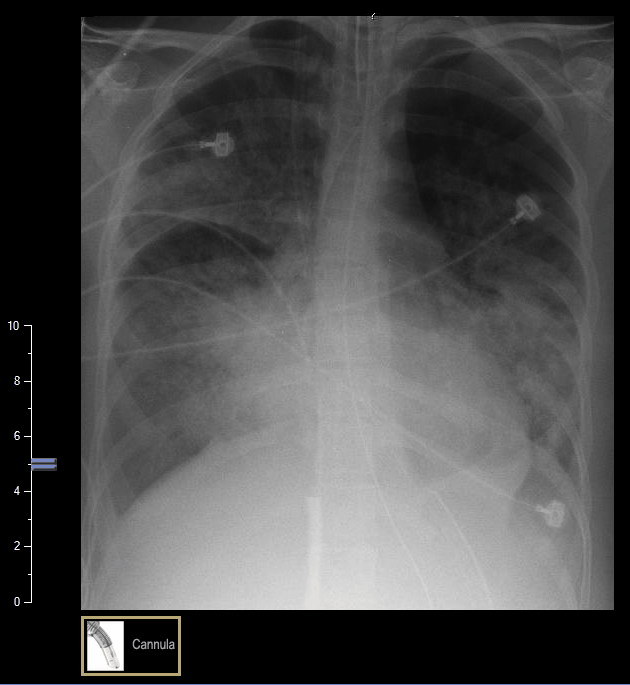 VA ECMO Cannula